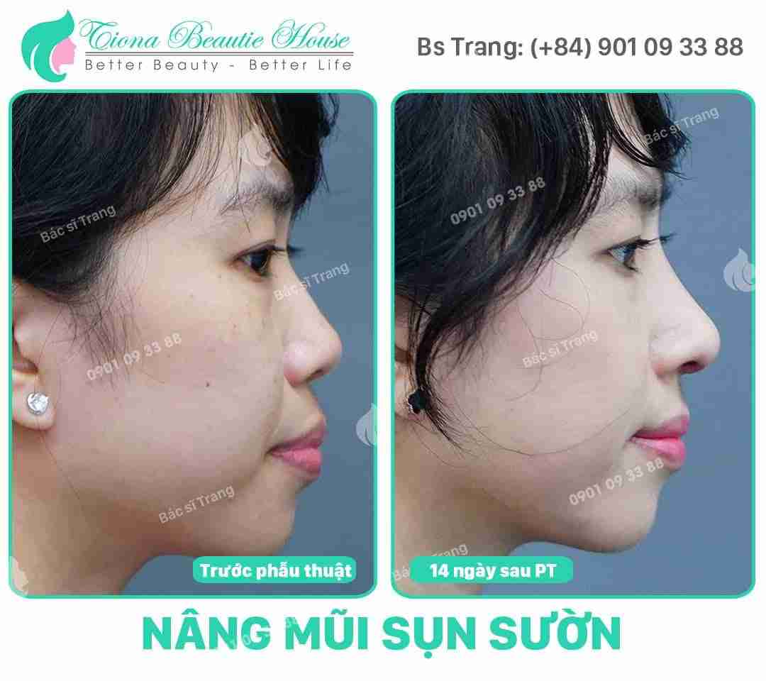 sửa mũi có đau không