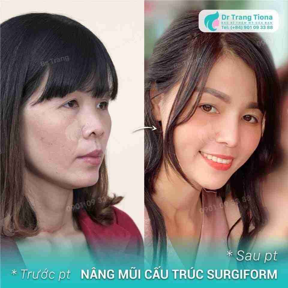 sửa mũi có đau không