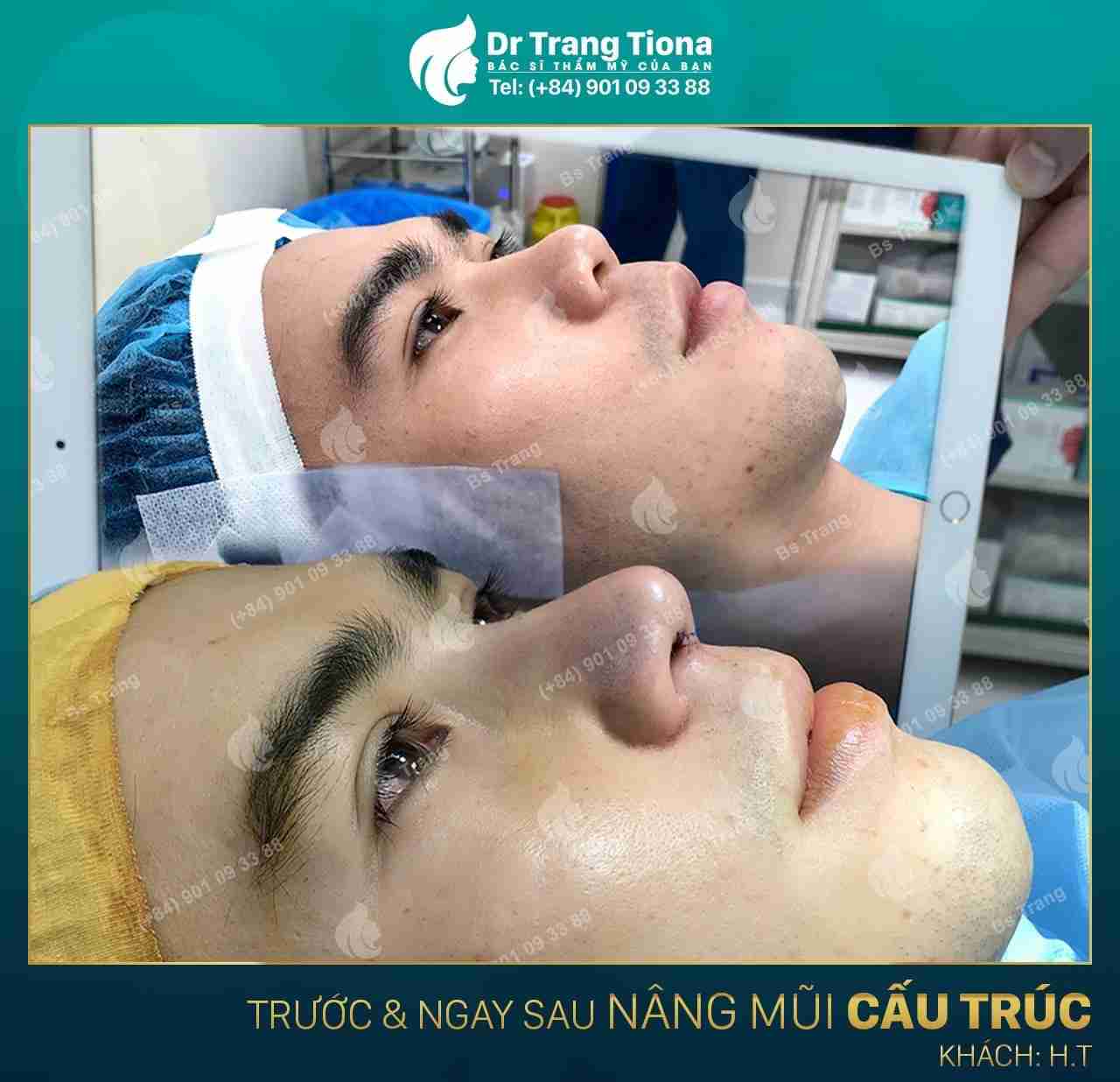 phẫu thuật sửa mũi tẹt