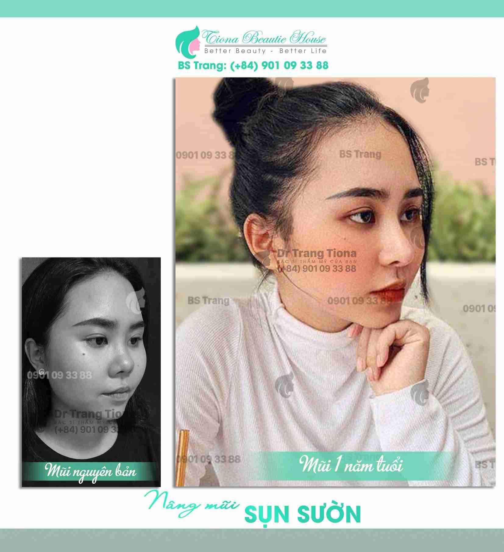 phẫu thuật sửa mũi tẹt