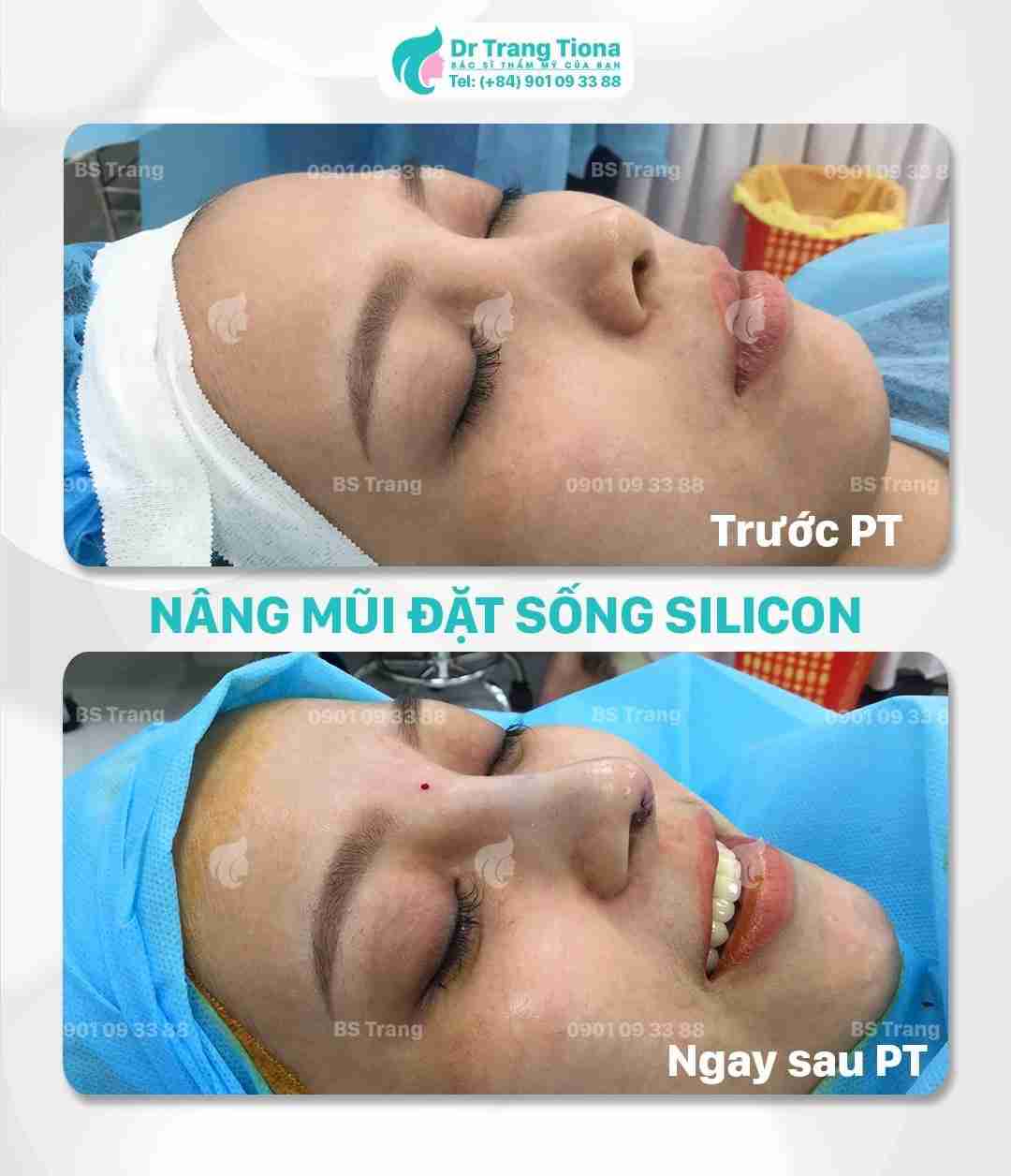 các loại sụn nâng mũi tốt hiện nay