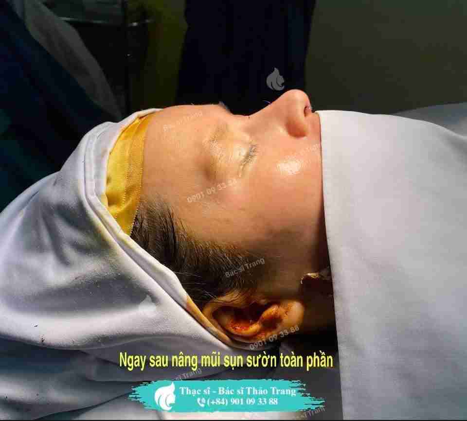 biến chứng thường gặp khi nâng mũi sụn sườn