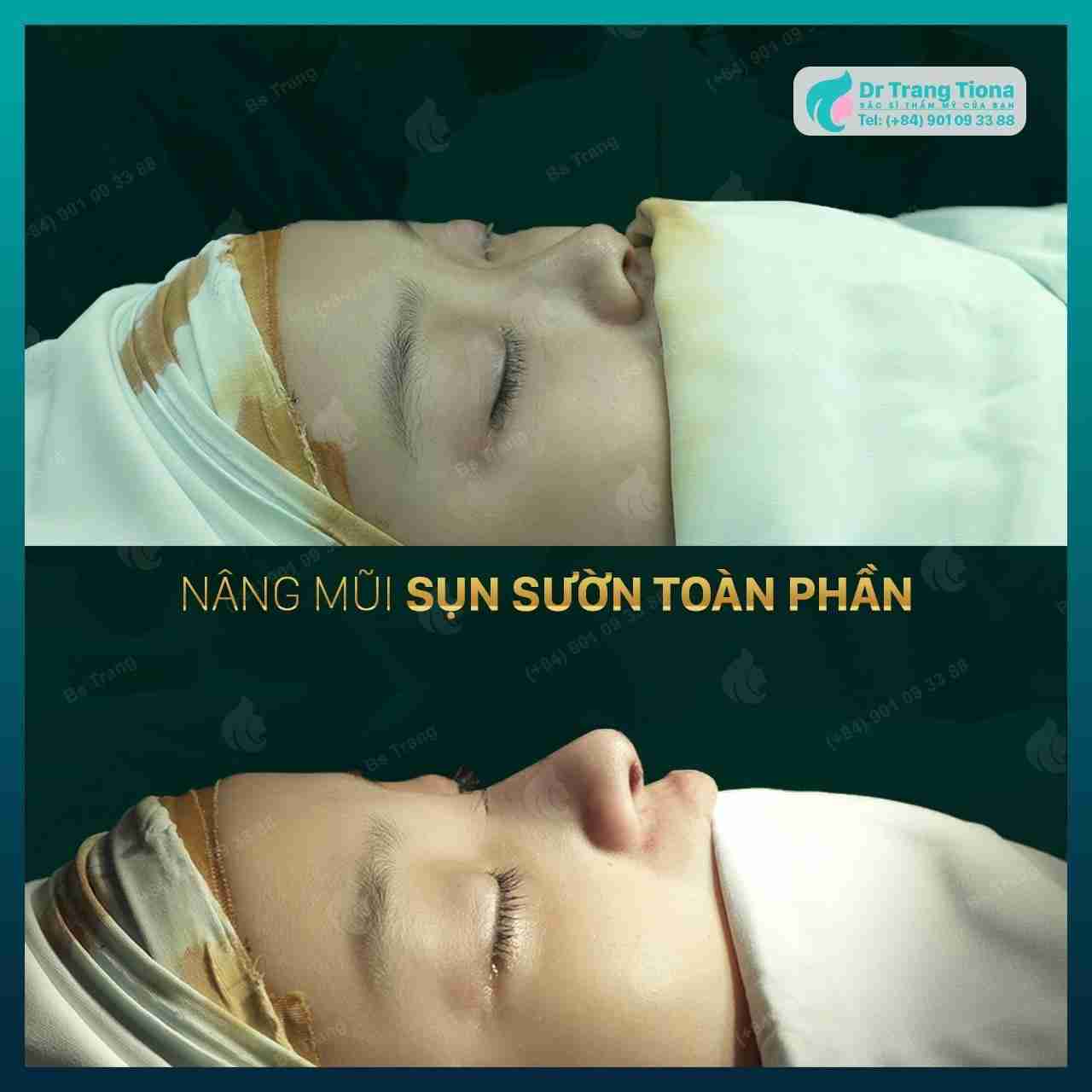 các loại sụn nâng mũi tốt hiện nay