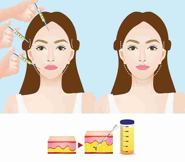 cấy mỡ mặt là gì