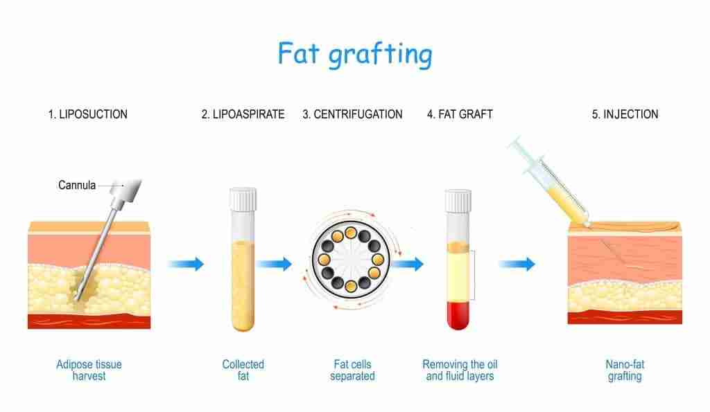 Cấy mỡ tự thân hốc mắt có nguy hiểm không