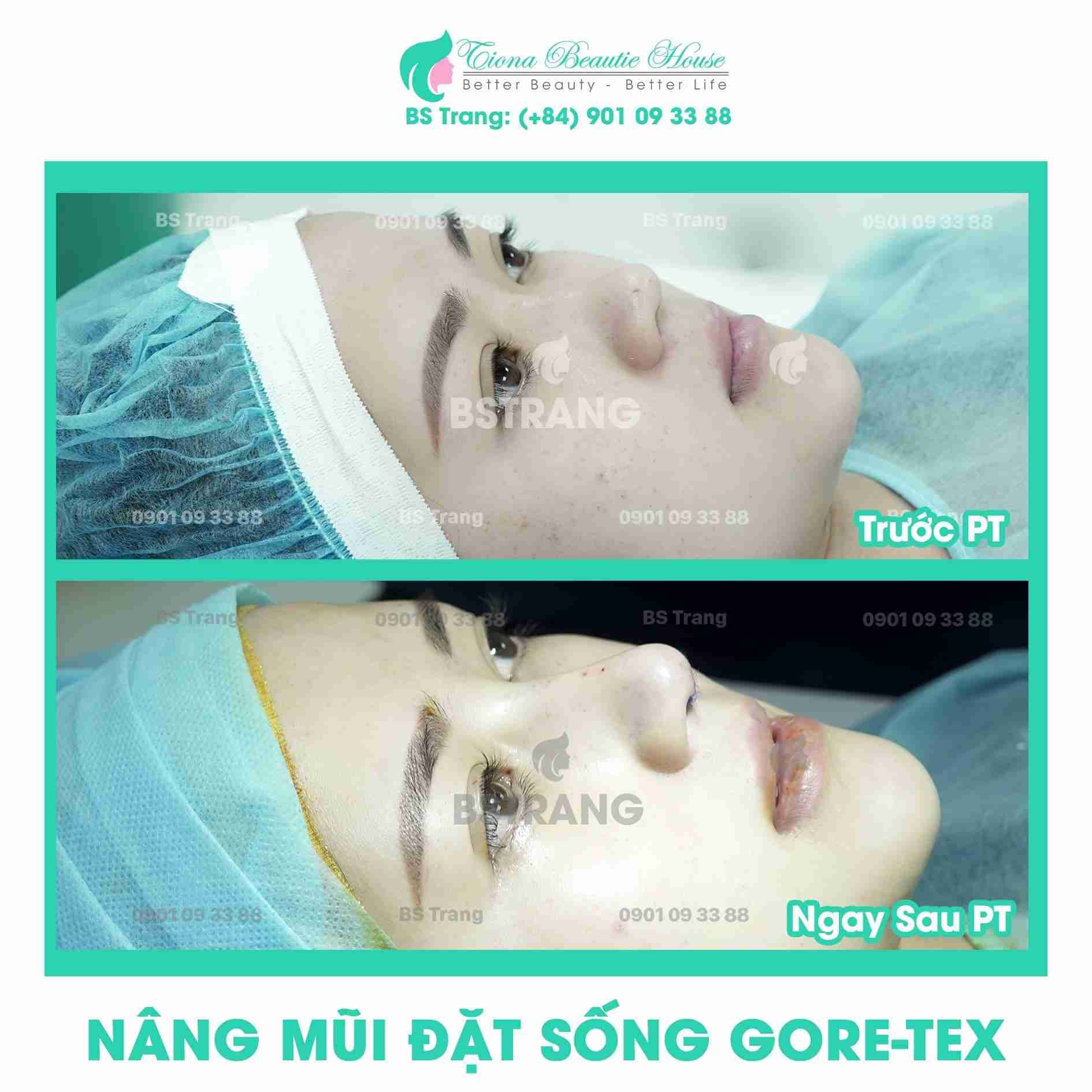 có nên vận động nhiều sau nâng mũi không
