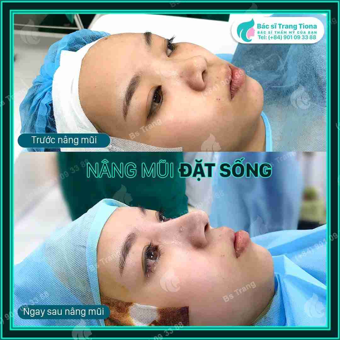 có nên vận động nhiều sau nâng mũi không