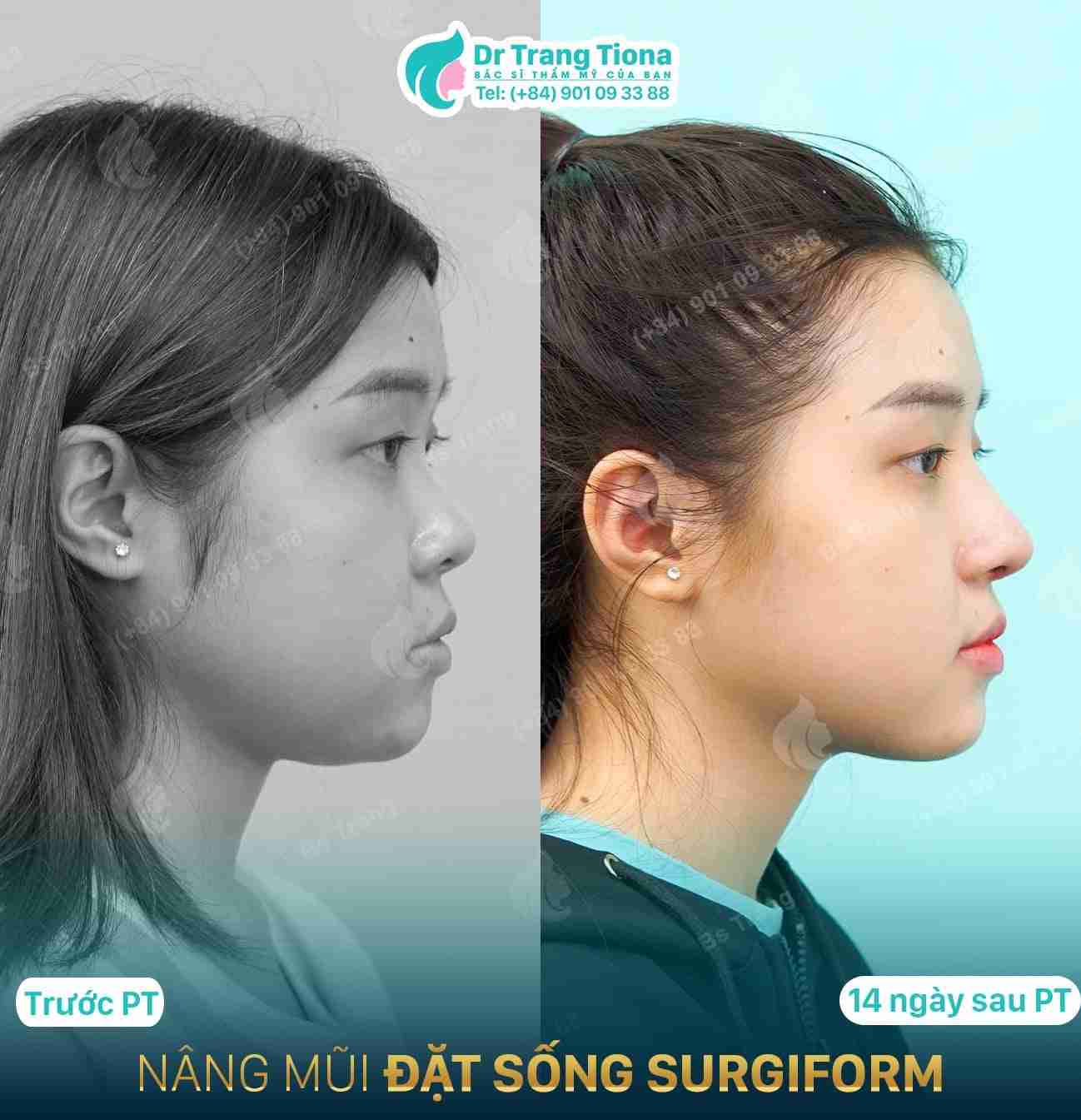 Da mũi mỏng có nâng mũi được không