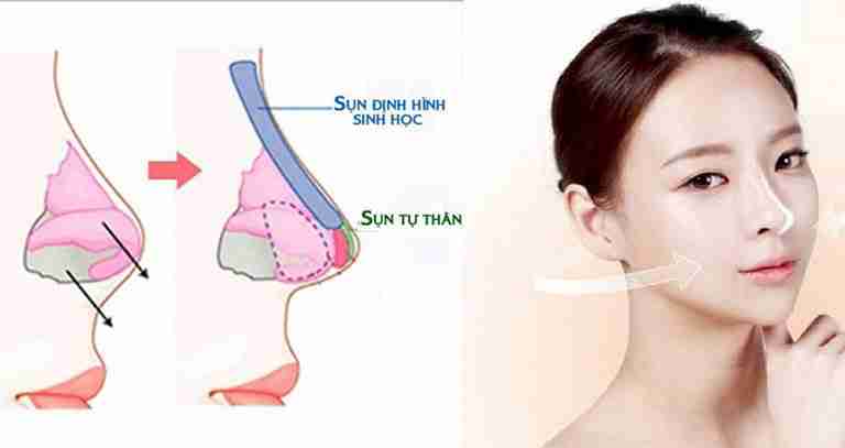 Da mũi mỏng có nâng mũi được không