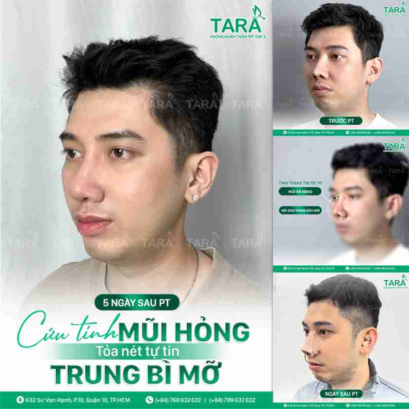 Thẩm mỹ mũi