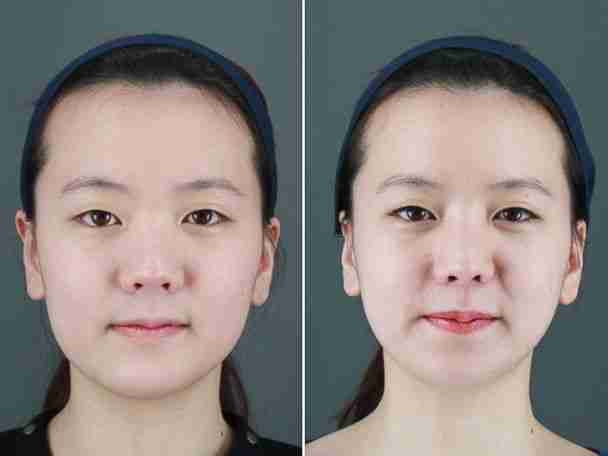 Cấy mỡ mặt Baby Face có hiệu quả lâu dài không