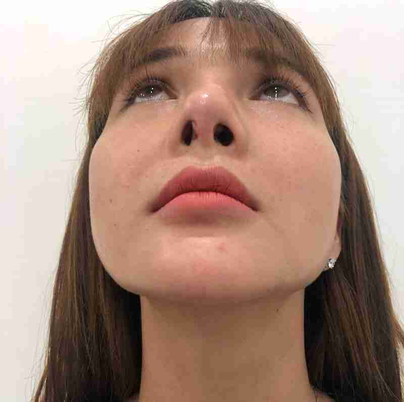 Ưu và nhược điểm của nâng mũi trung bì mỡ