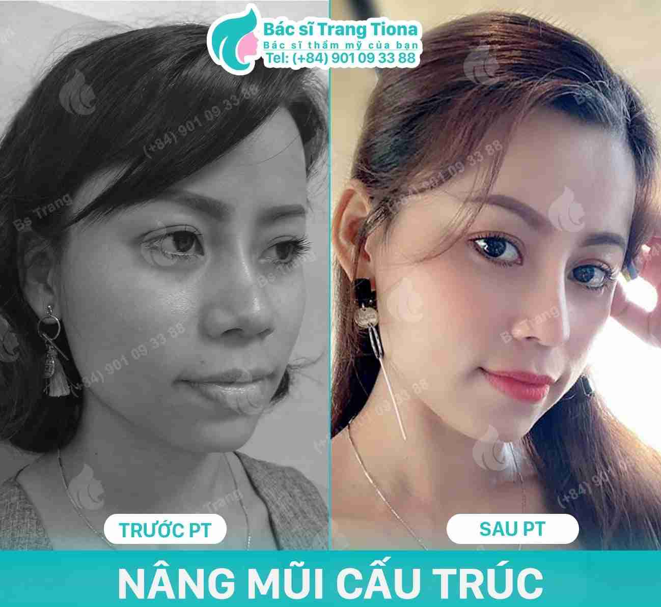 Nâng mũi cấu trúc là gì