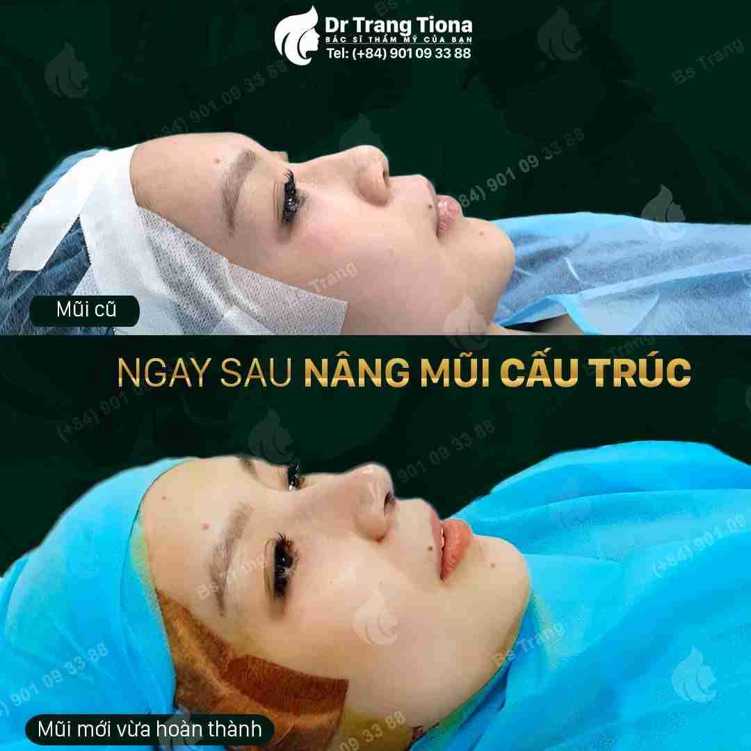 nâng mũi có thay đổi vận mệnh