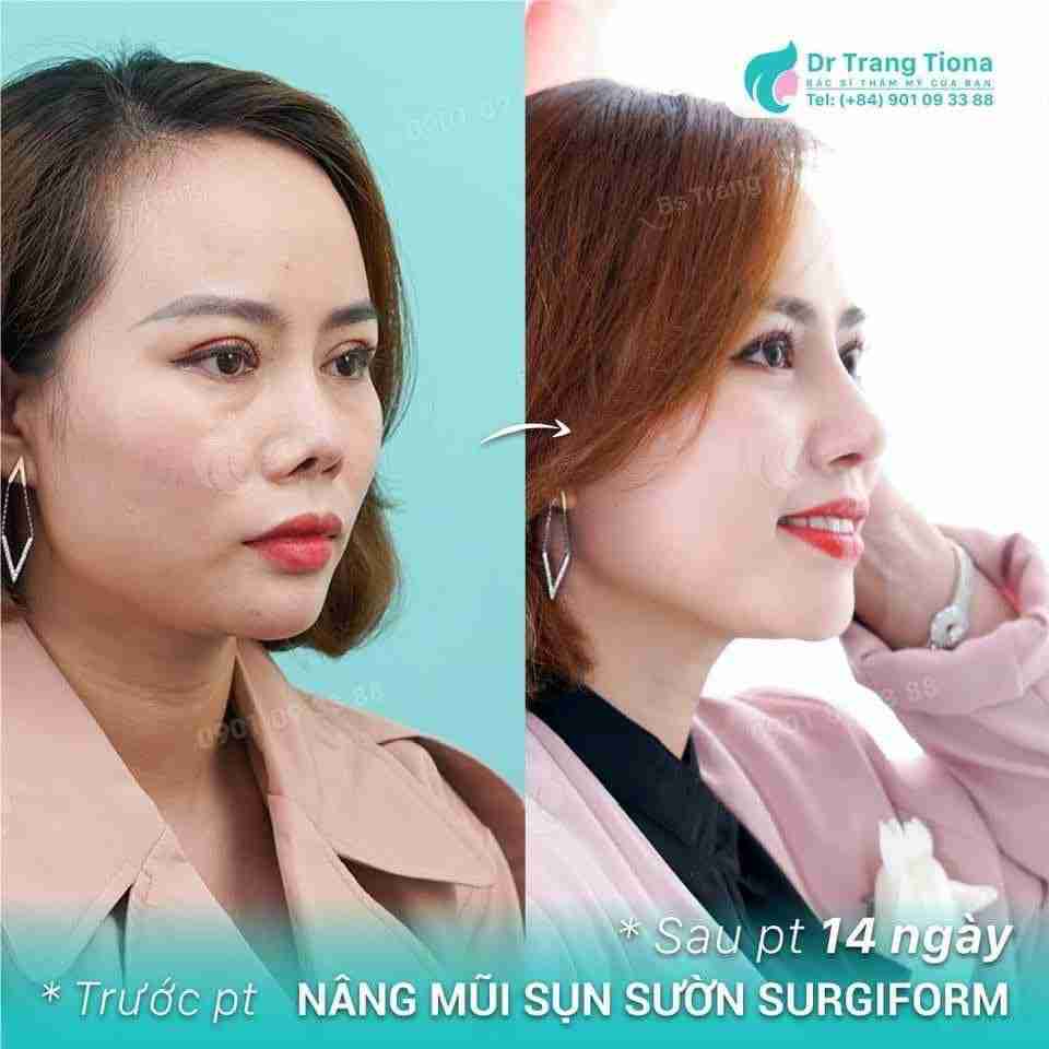 Hình ảnh nâng mũi cấu trúc sau 14 ngày
