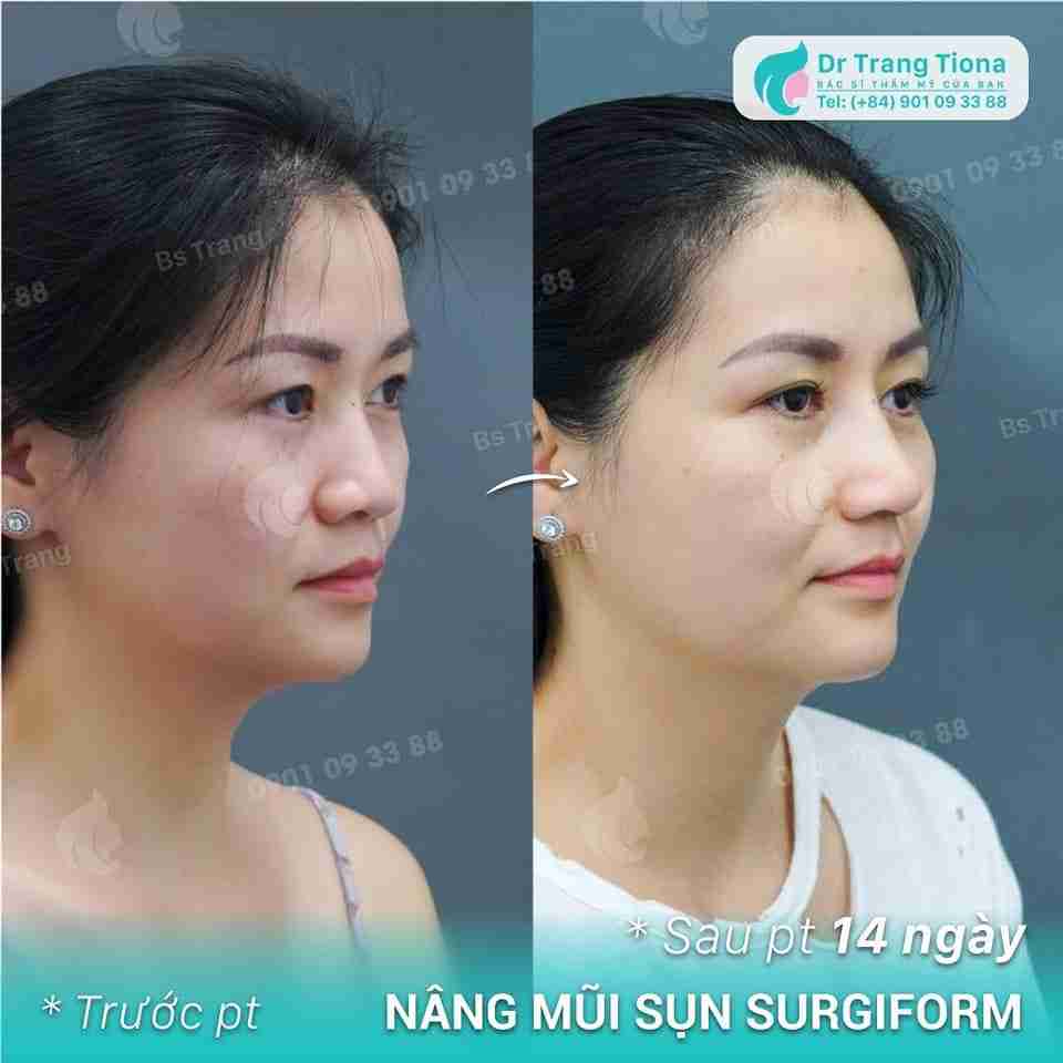 Hình ảnh nâng mũi cấu trúc sau 14 ngày