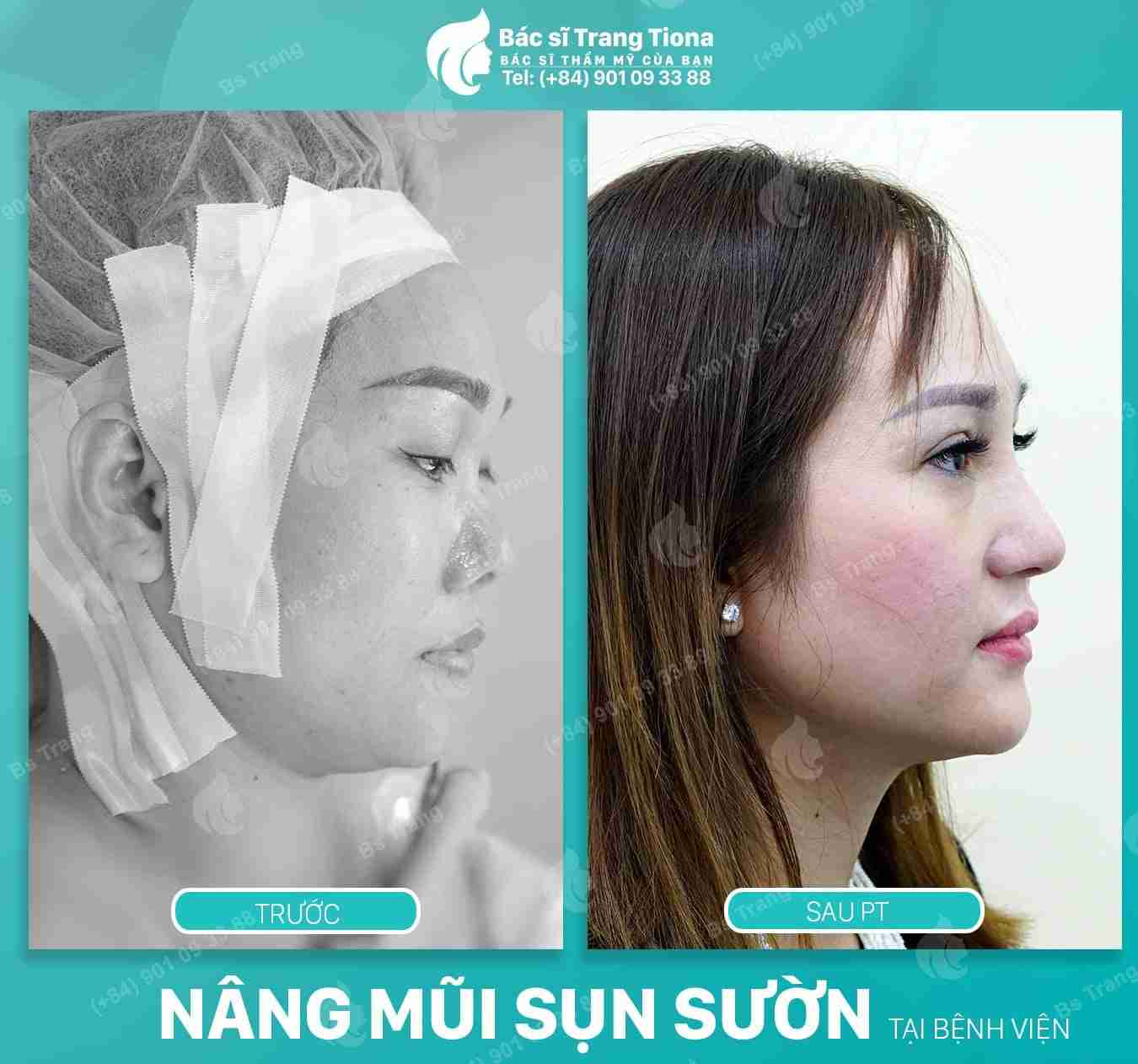 Nâng mũi sụn sườn bao lâu thì đẹp
