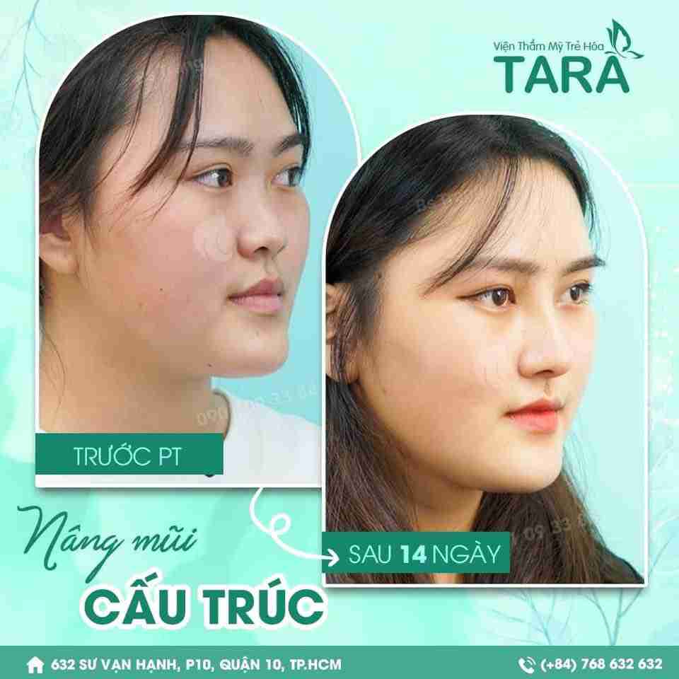  Trước khi nâng mũi có được ăn không