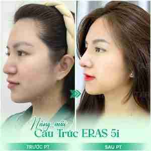 nâng mũi cấu trúc nâng mũi cấu trúc