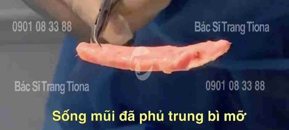 Ai nên cấy mỡ trung bì vào mũi?
