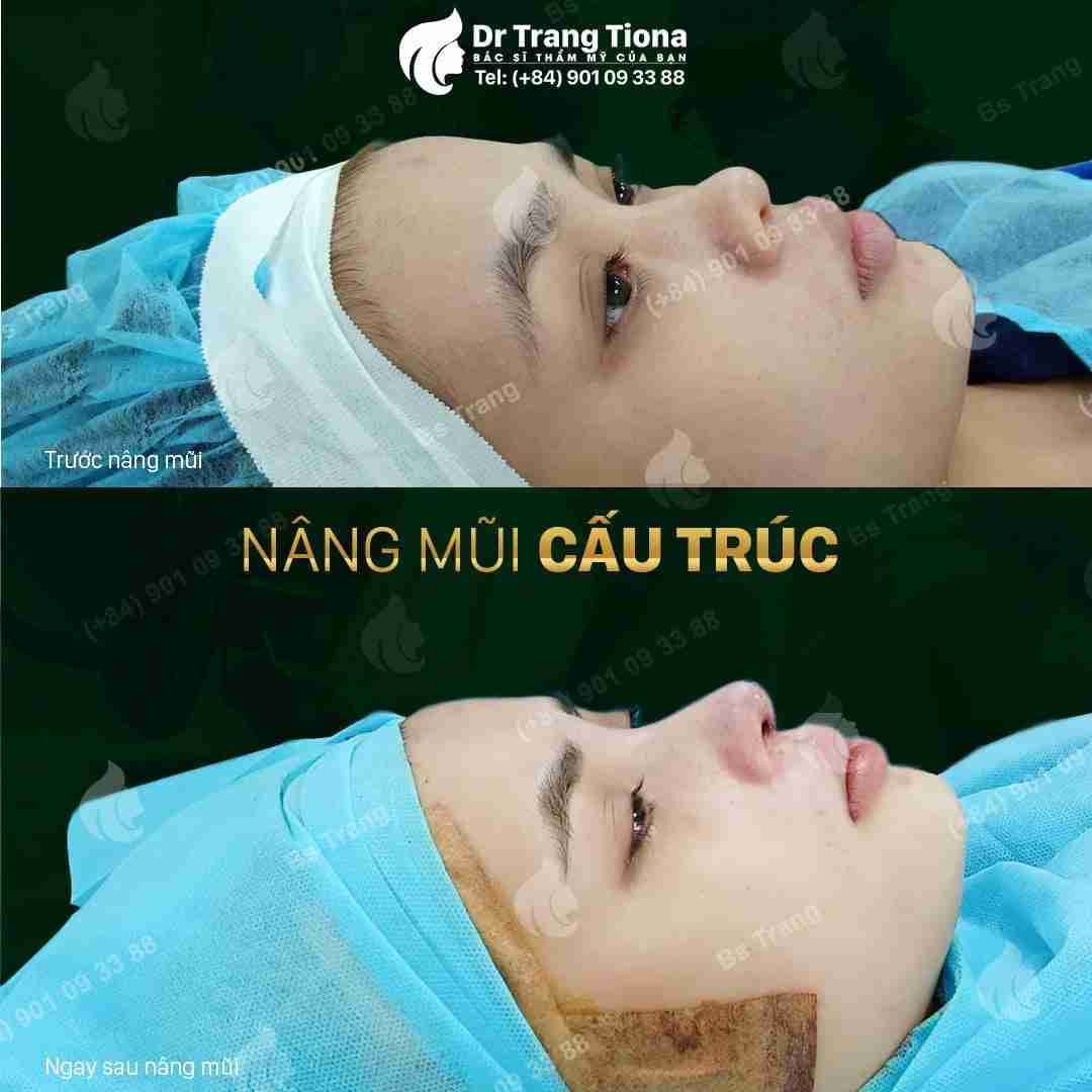  ai nên nâng mũi cấu trúc?