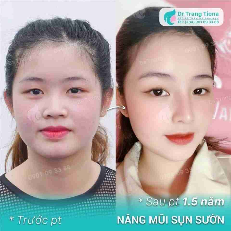 dáng mũi phù hợp cho người mặt tròn