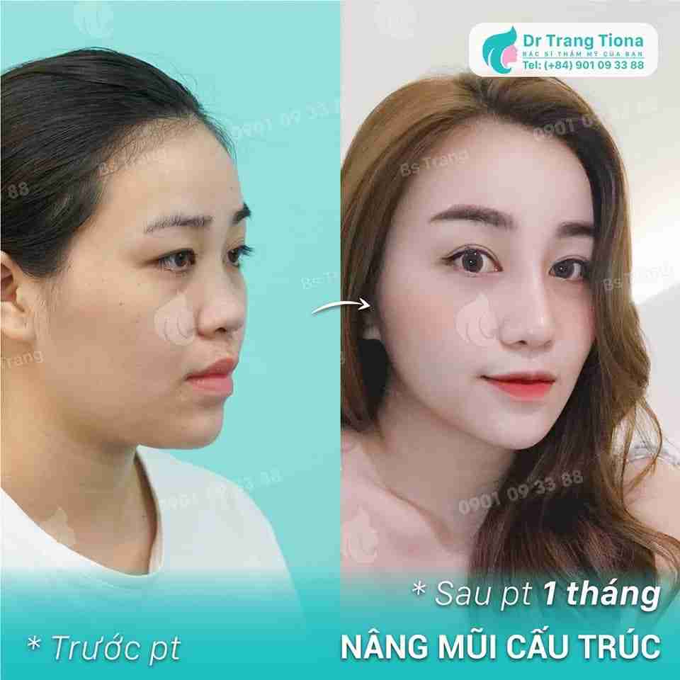Có nên nâng mũi bây giờ để kịp đón Tết