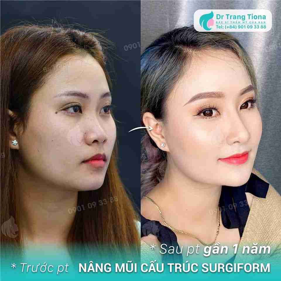 Nâng mũi kiêng nằm nghiêng bao lâu