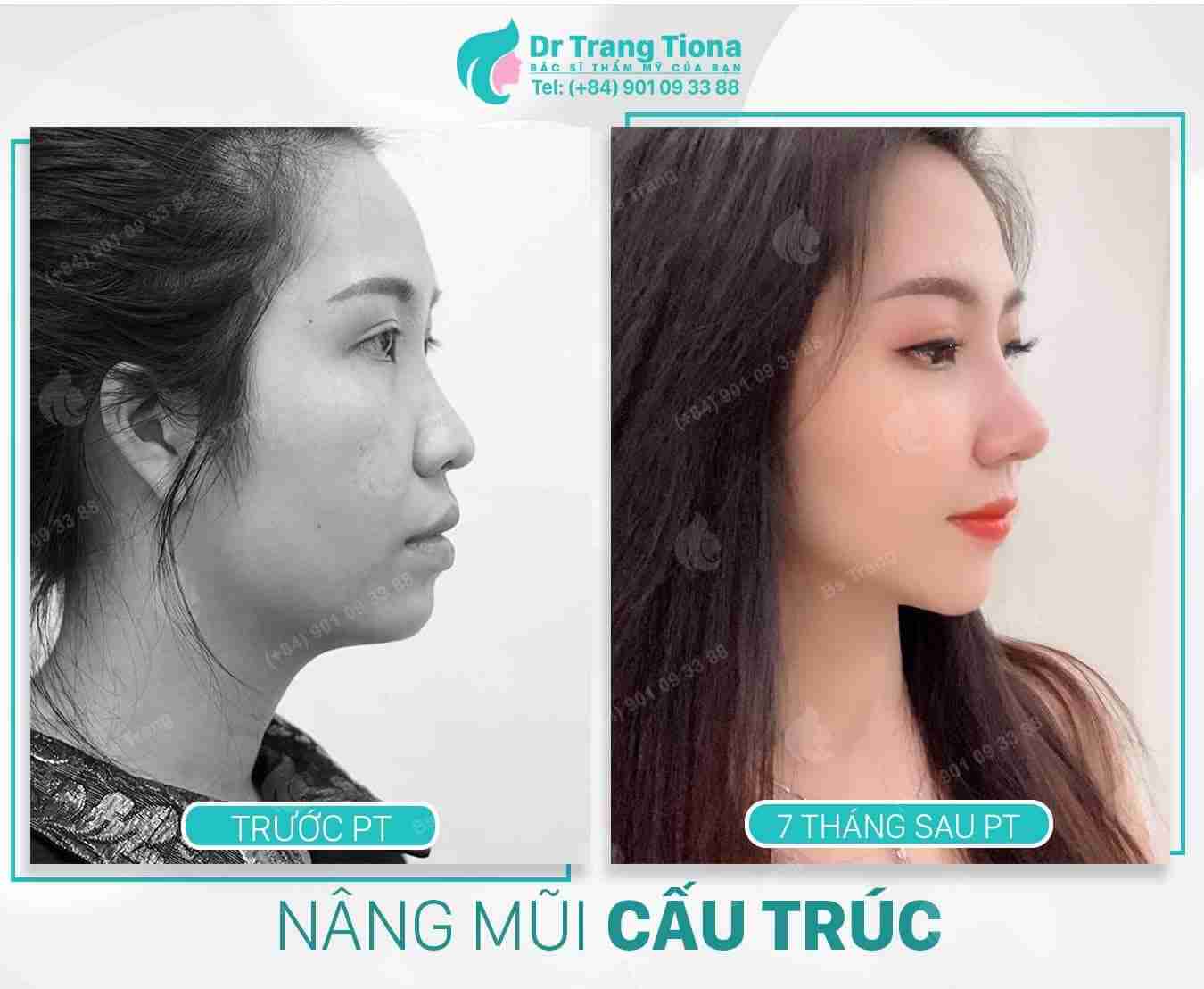Nâng mũi cấu trúc có đắt không? Giá bao nhiêu?