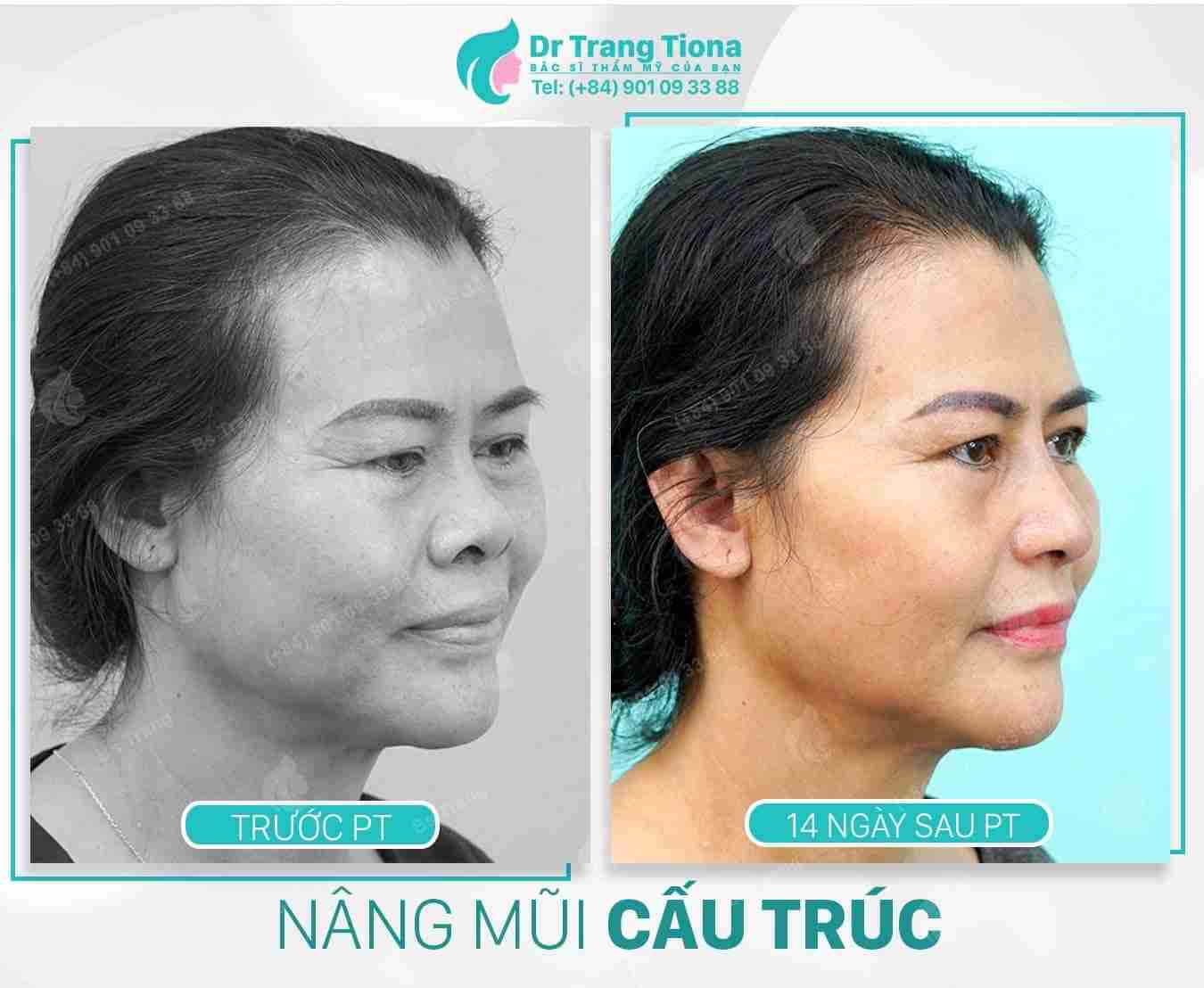 Nâng mũi cấu trúc có đắt không? Giá bao nhiêu?