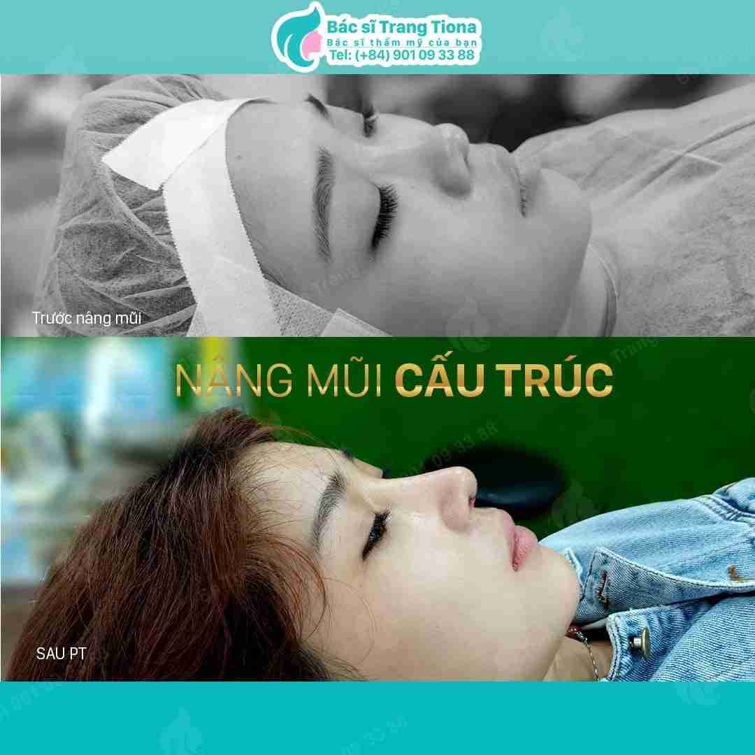 Nâng mũi cấu trúc có đắt không? Giá bao nhiêu?