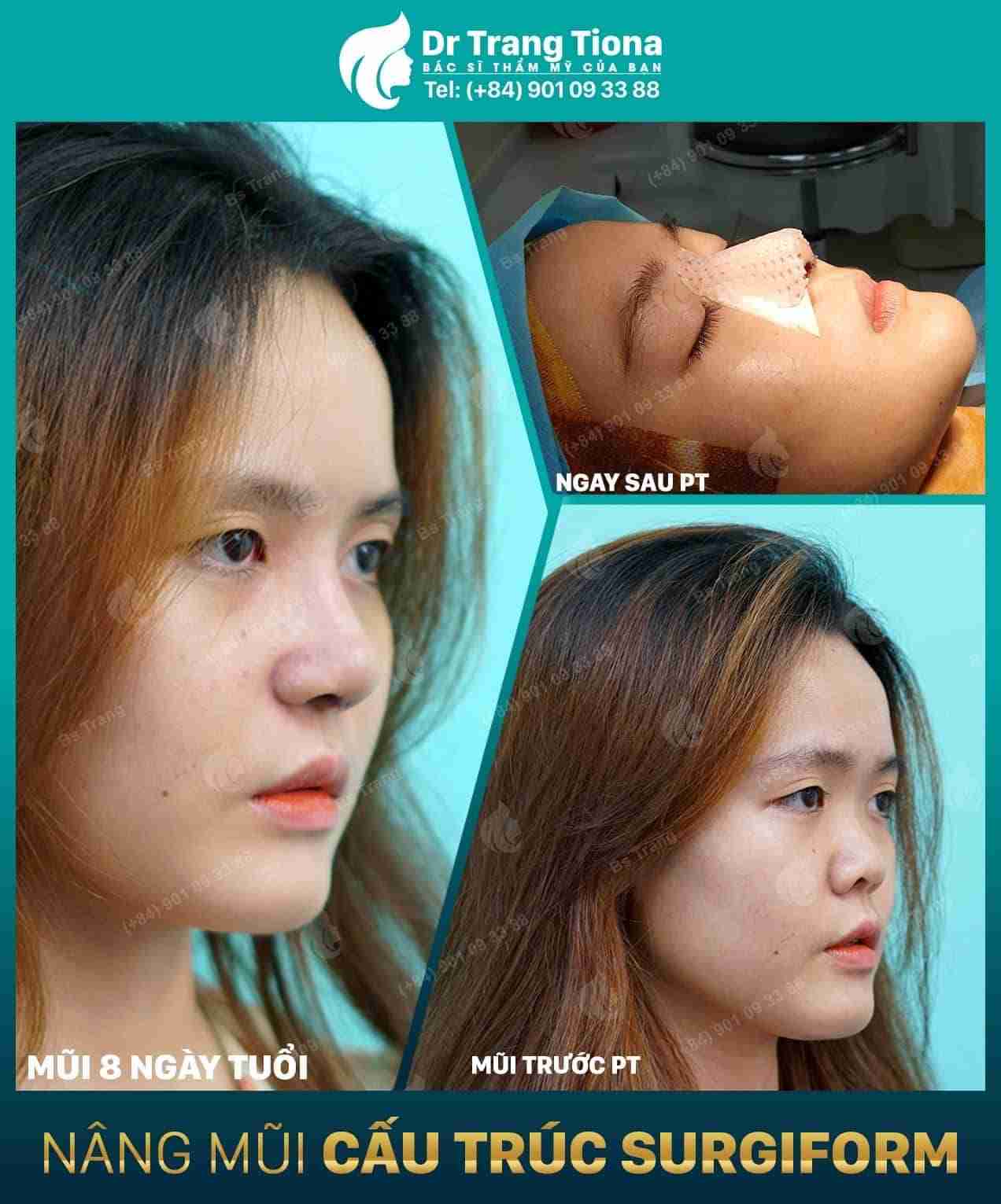 Nâng mũi cấu trúc duy trì hiệu quả bao lâu?