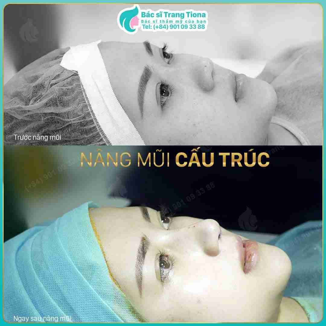 Nâng mũi cấu trúc duy trì hiệu quả bao lâu?