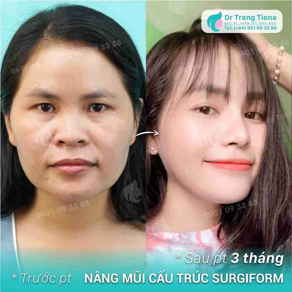 Nâng mũi có thay đổi khuôn mặt không