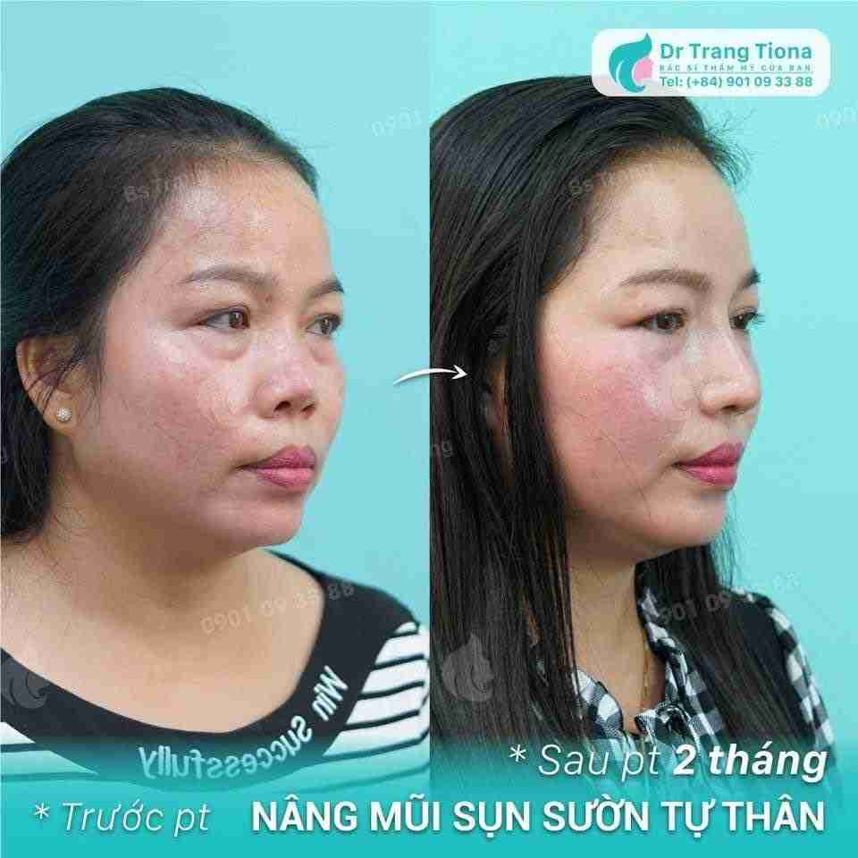 Sửa mũi bao lâu thì đẹp tự nhiên
