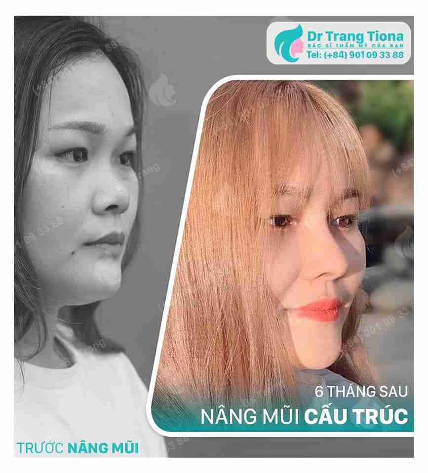 Sửa mũi bao lâu thì đẹp tự nhiên