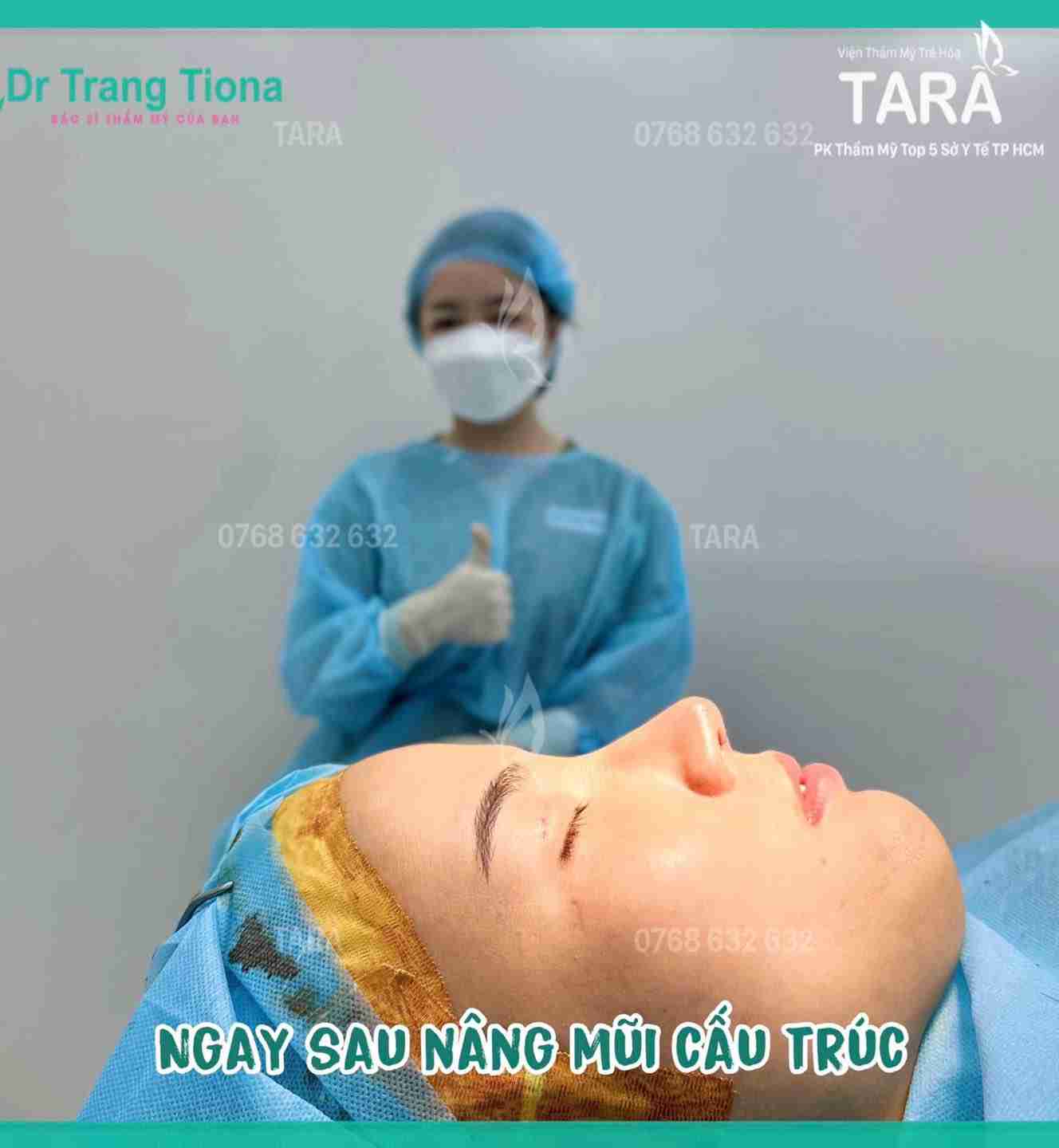 Sửa mũi bao lâu thì đẹp tự nhiên