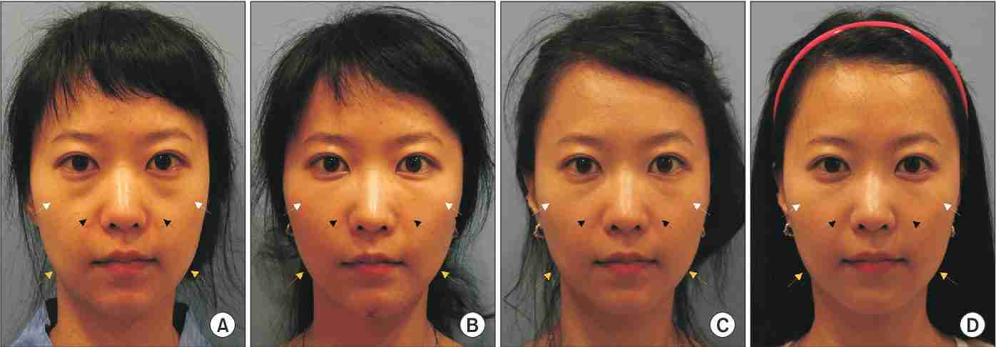 Cấy mỡ mặt Baby Face được thực hiện như thế nào