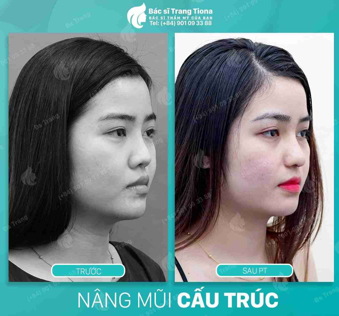 Có nên nâng mũi Sline Hàn Quốc không?
