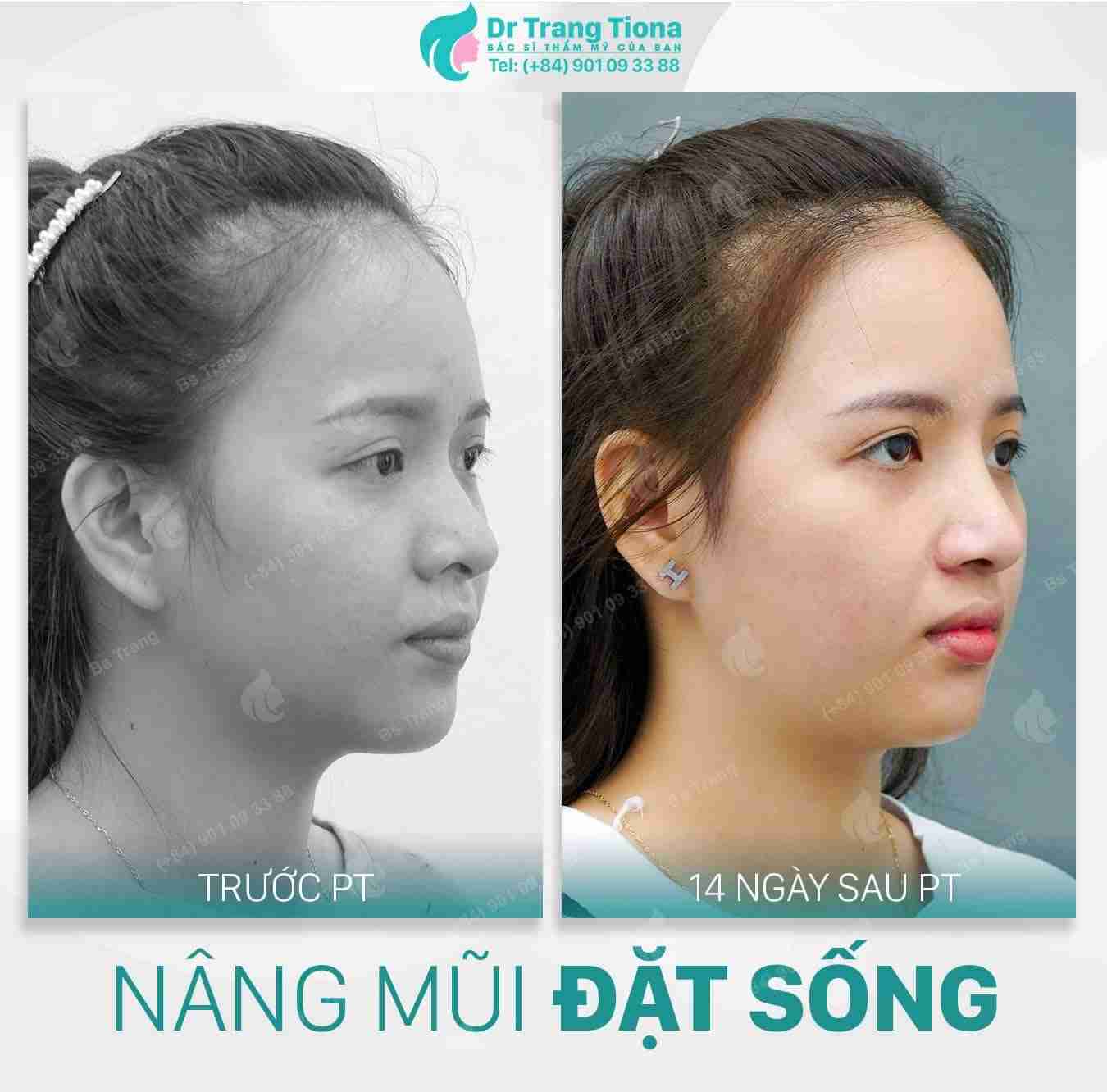 Có nên nâng mũi Sline Hàn Quốc không?