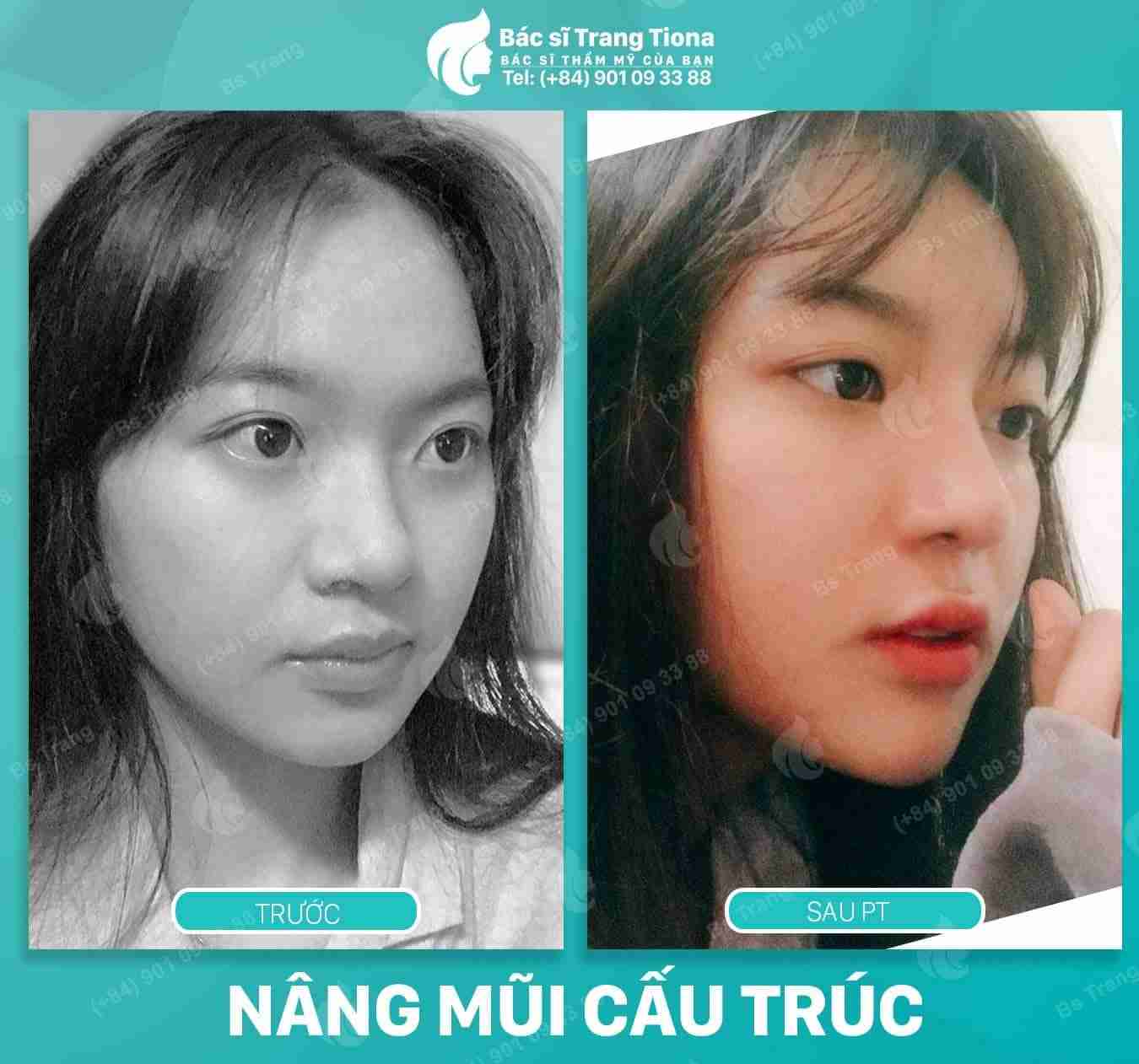 Có nên nâng mũi Sline Hàn Quốc không?