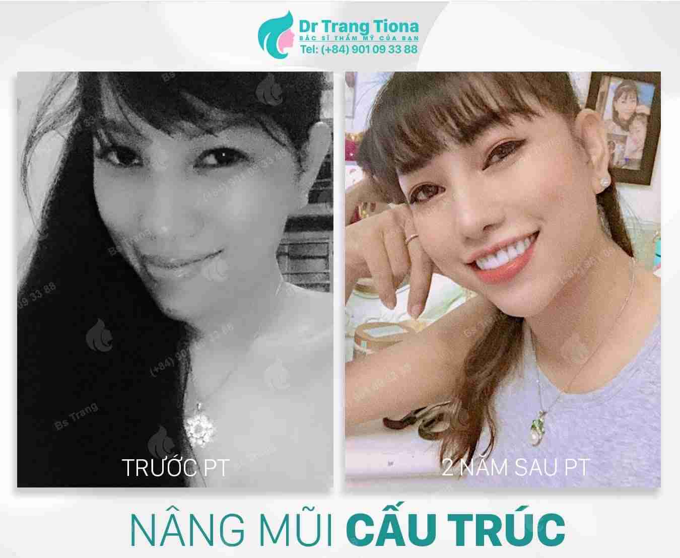 Dáng mũi phù hợp cho người mặt vuông đẹp và sang