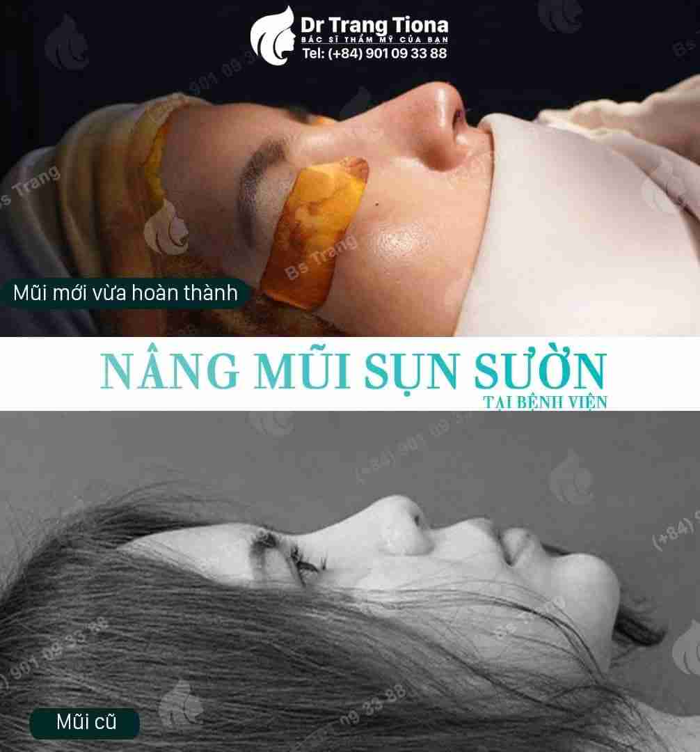 Ưu và nhược điểm của các loại sụn tự thân trong nâng mũi