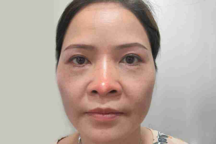  Mũi bị xơ cứng 