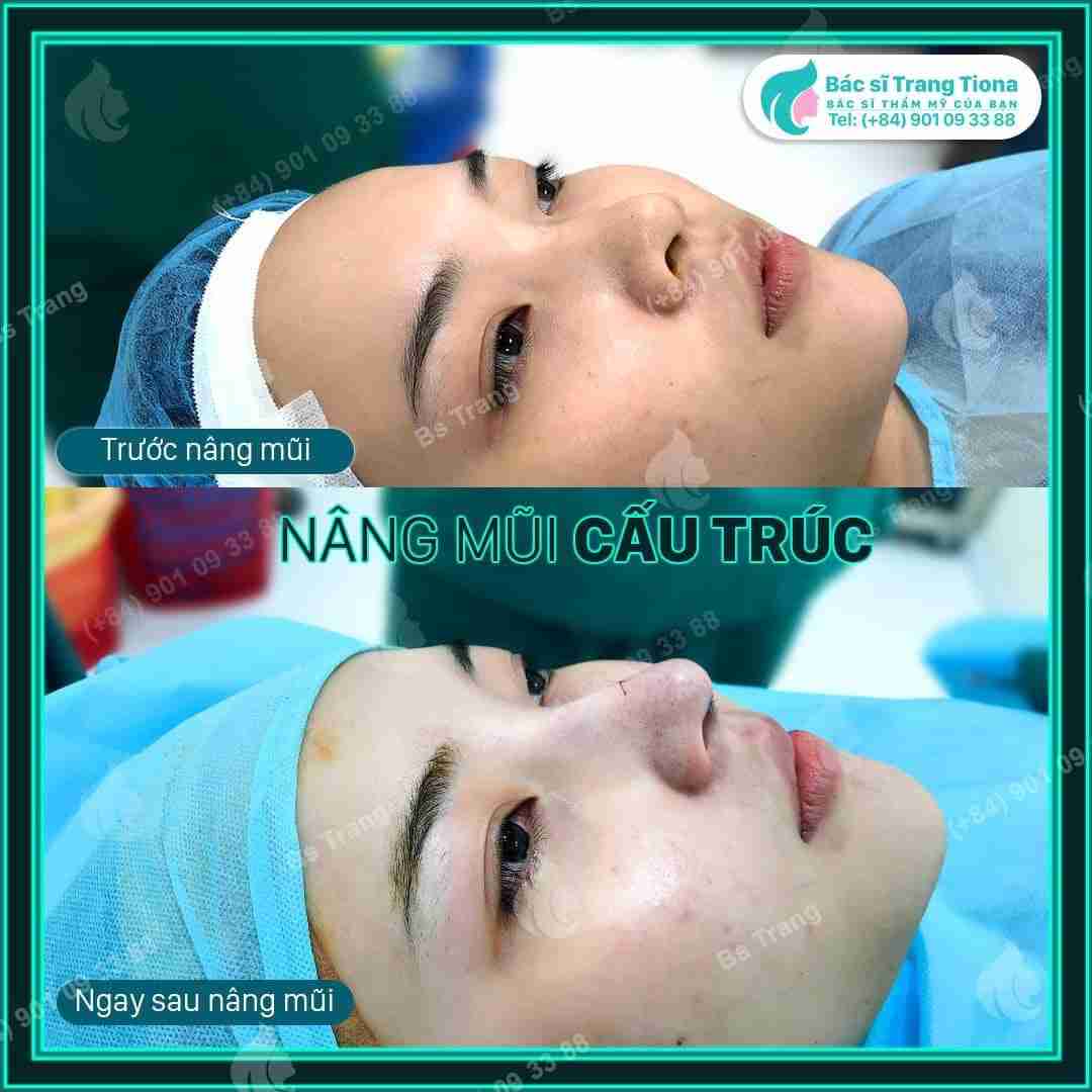 Review nâng mũi bác sĩ Trang