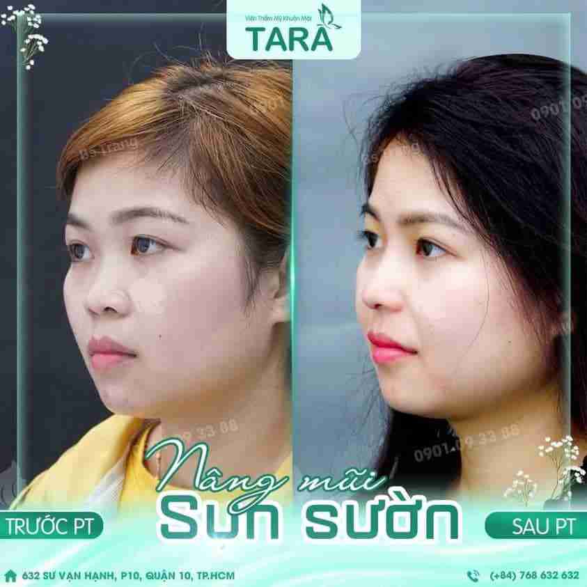 Review nâng mũi bác sĩ Trang