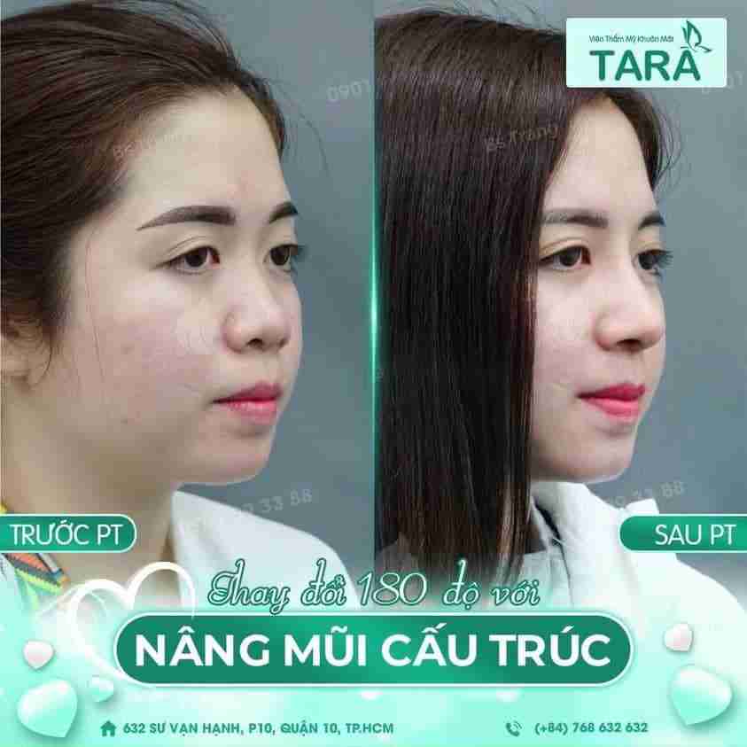Review nâng mũi bác sĩ Trang