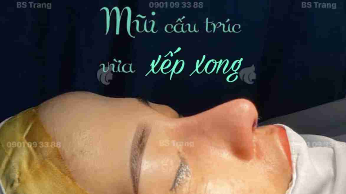 Khách hàng thực hiện nâng mũi bác sĩ Trang