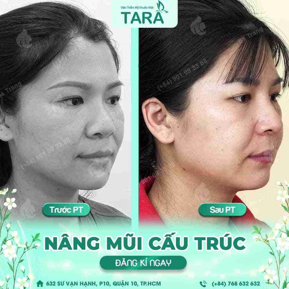 Nâng mũi cấu trúc bác sĩ Trang có vĩnh viễn không? 