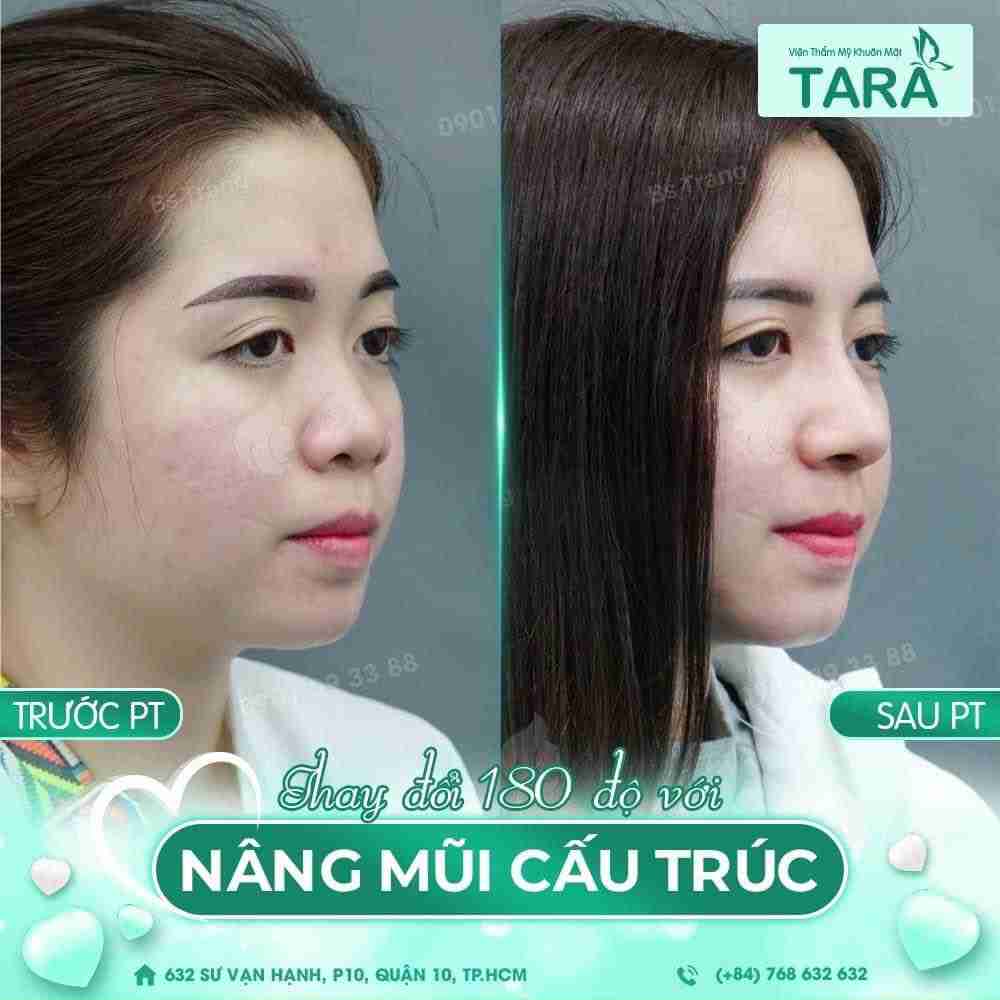 Nâng mũi cấu trúc bác sĩ Trang có vĩnh viễn không? 